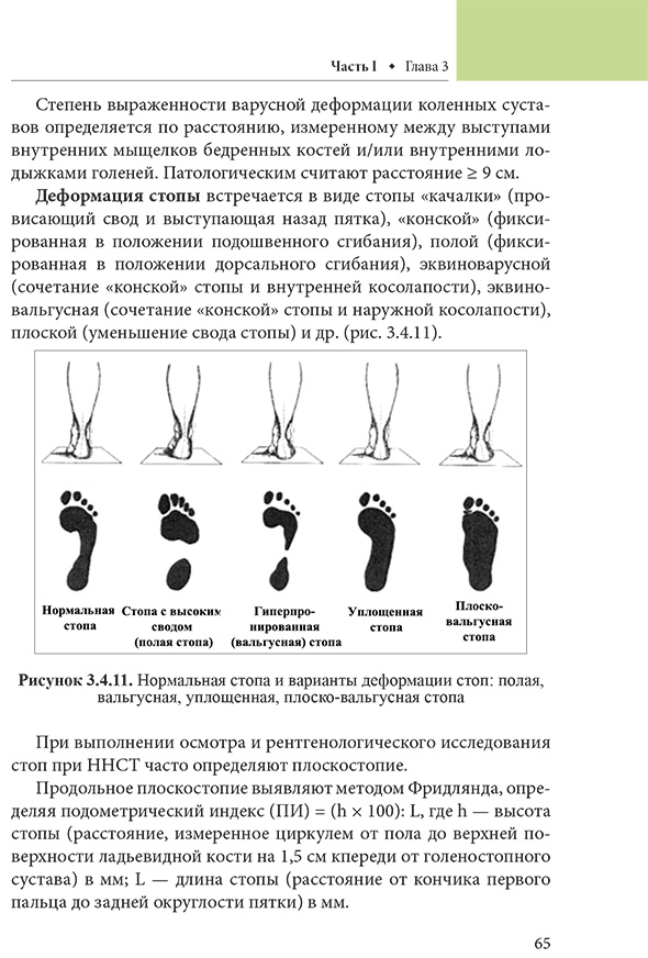 Рисунок 3.4.11. Нормальная стопа и варианты деформации стоп: полая, вальгусная, уплошснная. плоско-вальгусная стопа