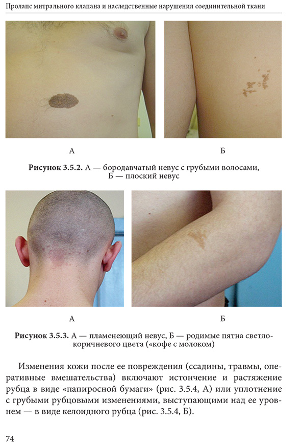 Рисунок 3.5.3. А — пламенеющий невус, Б — родимые пятна светло-коричневого цвета («кофе с молоком)