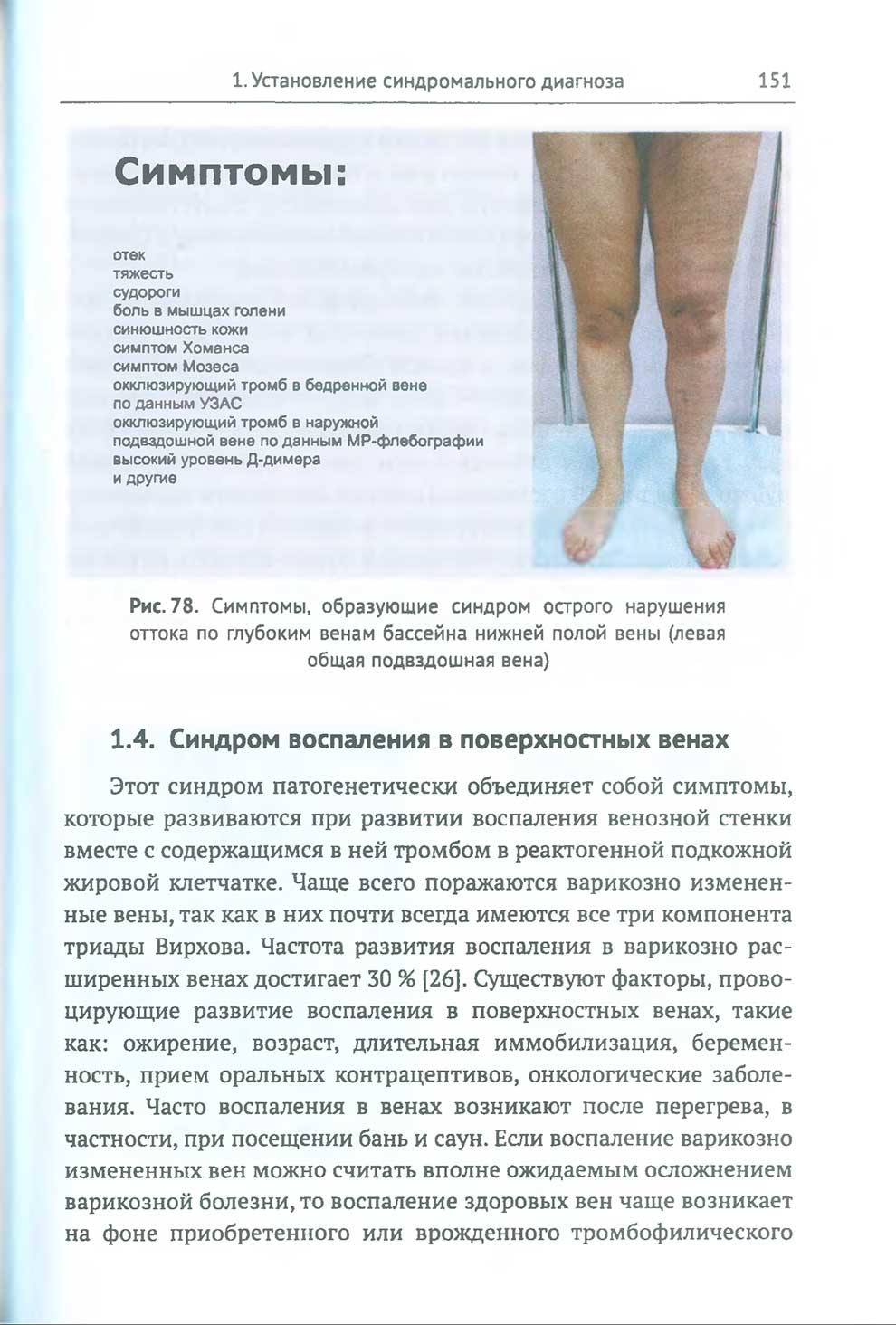 Симптомы, образующие синдром острого нарушения оттока по глубоким венам бассейна нижней полой вены (левая общая подвздошная вена)