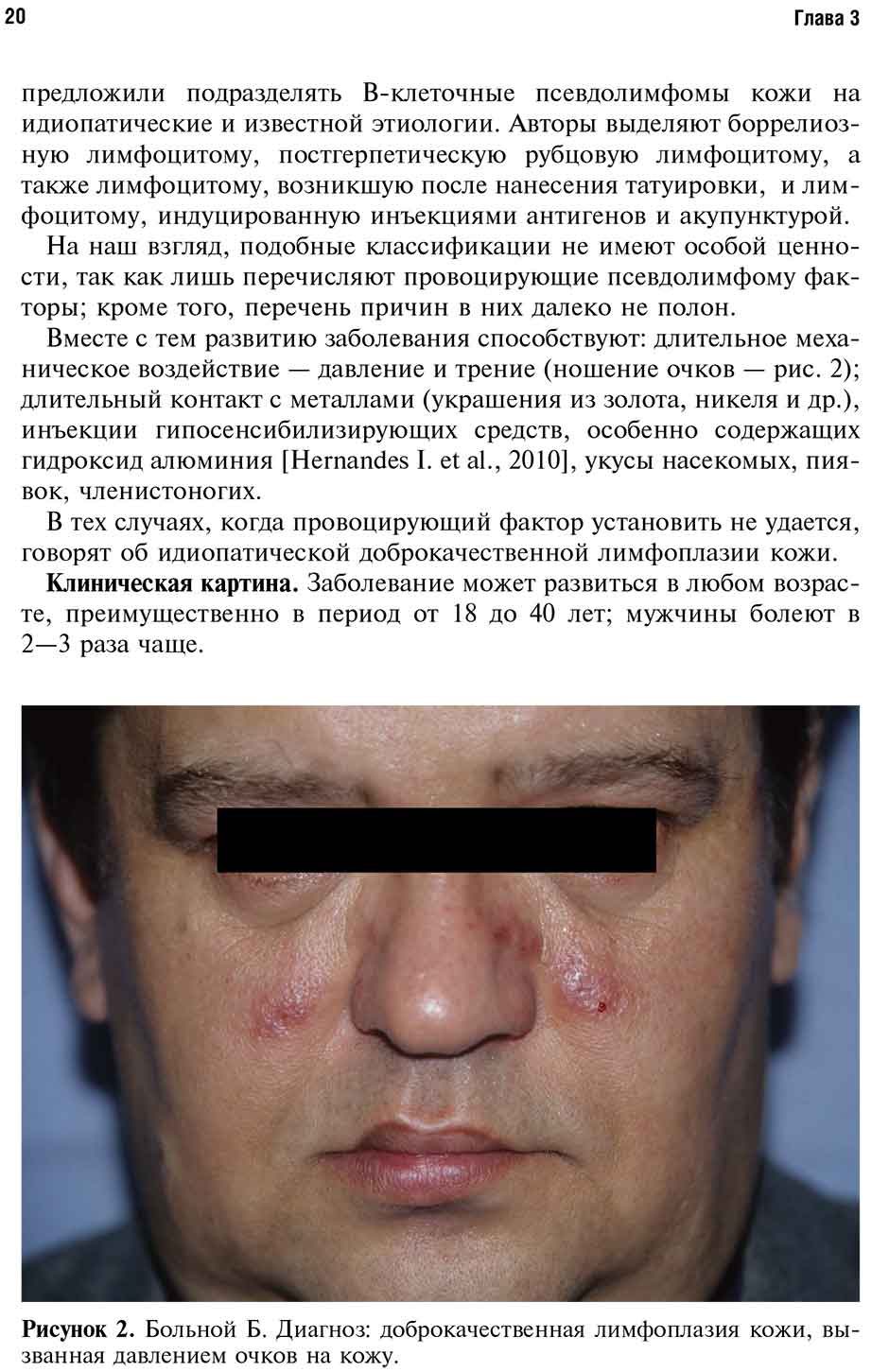 Рисунок 2. Больной Б. Диагноз: доброкачественная лимфоплазия кожи