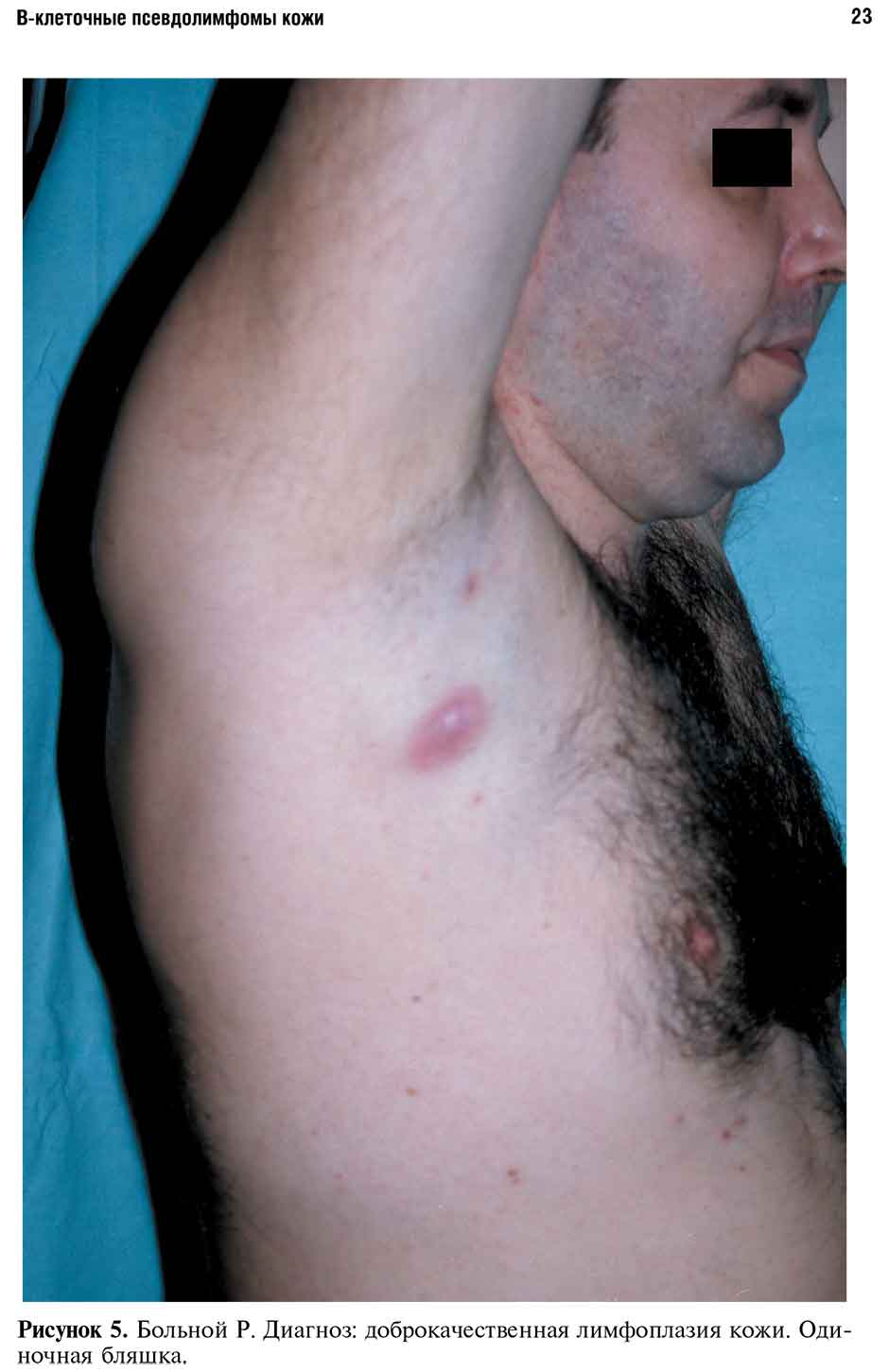Рисунок 5. Больной Р. Диагноз: доброкачественная лимфоплазия кожи.