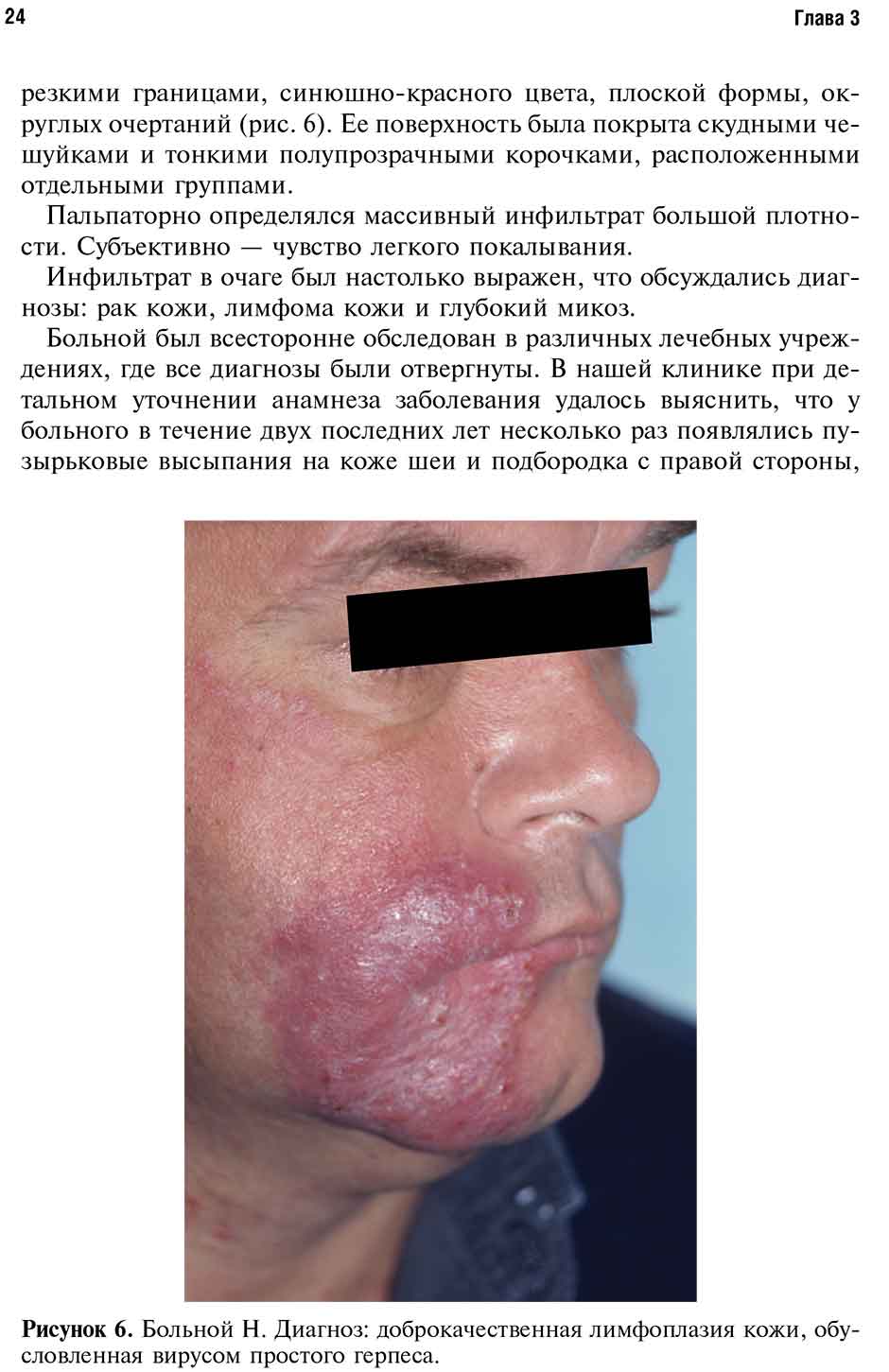 лч 6. Больной Н. Диагноз: доброкачественная лимфоплазия кожи