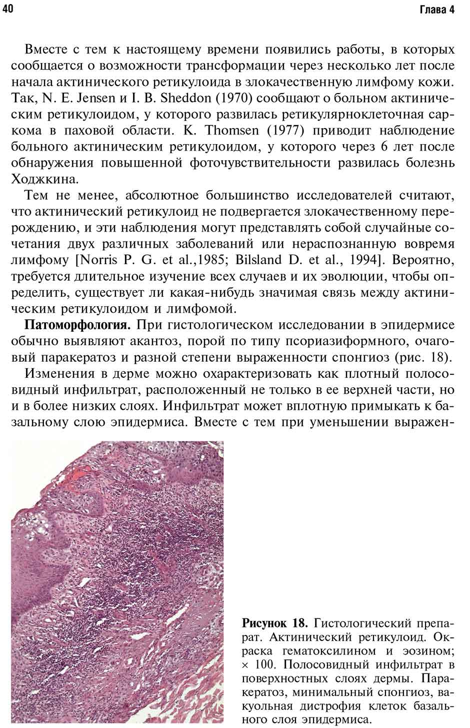 Рисунок 18. Гистологический препарат. Актинический ретикулоид. 