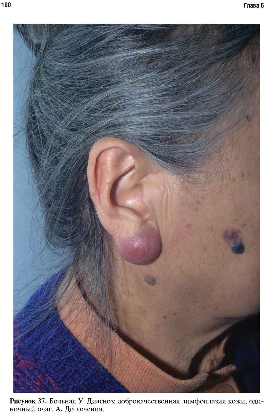 Рисунок 37. Больная У. Диагноз: доброкачественная лимфоплазия кожи