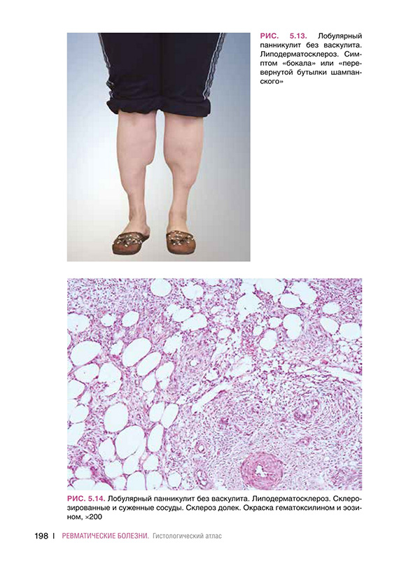 Лобулярный панникулит без васкулита.