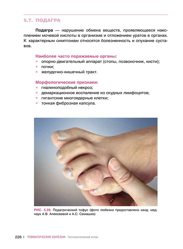 Подагрический тофус