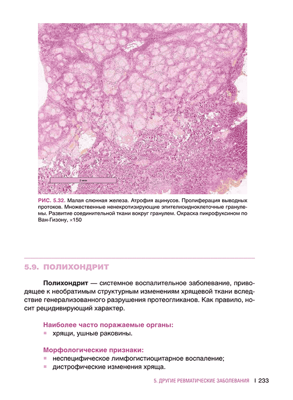 Малая слюнная железа. Атрофия ацинусов.