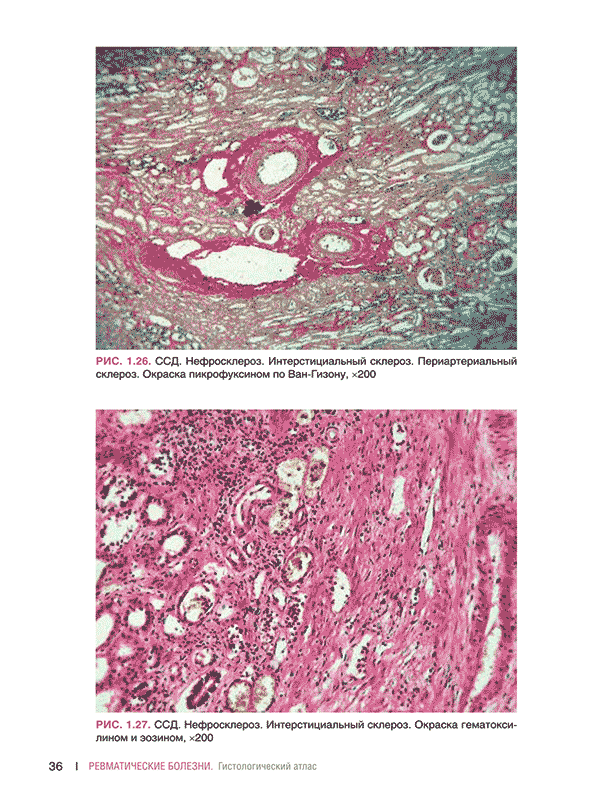 Нефросклероз. Интерстициальный склероз.