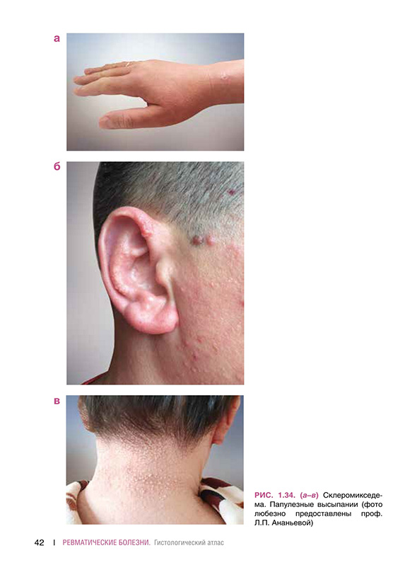 Склсромиксодема. Папулезные высылании