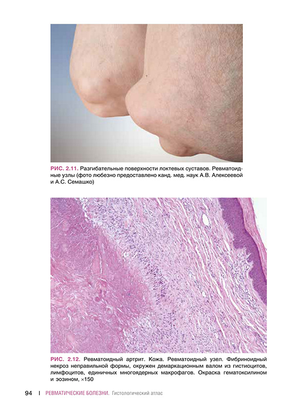 Ревматоидный артрит. Кожа.