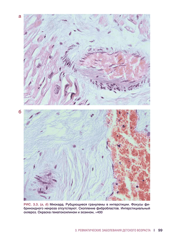 Миокард, рубцующиеся гранулемы в интерстиции.