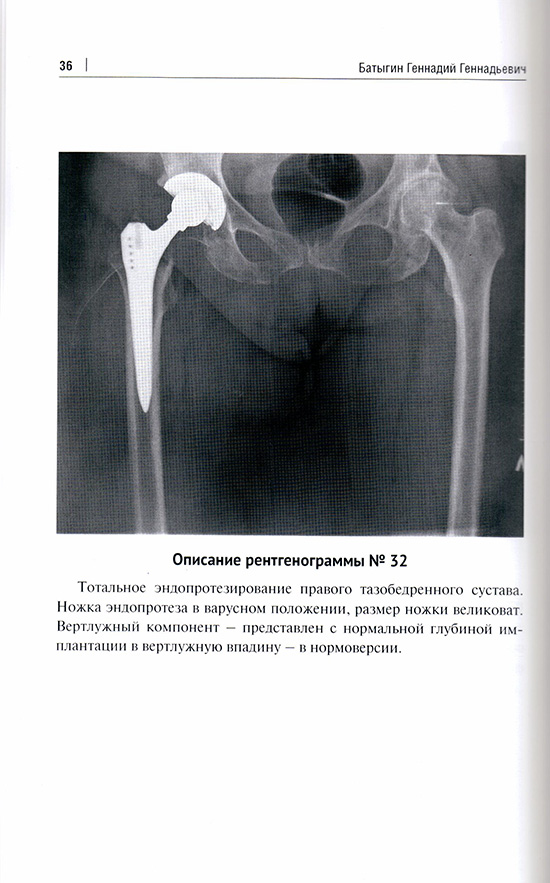 Тотальное эндопротезирование правого тазобедренною сустава. Тотальное эндопротезирование правого тазобедренною сустава.