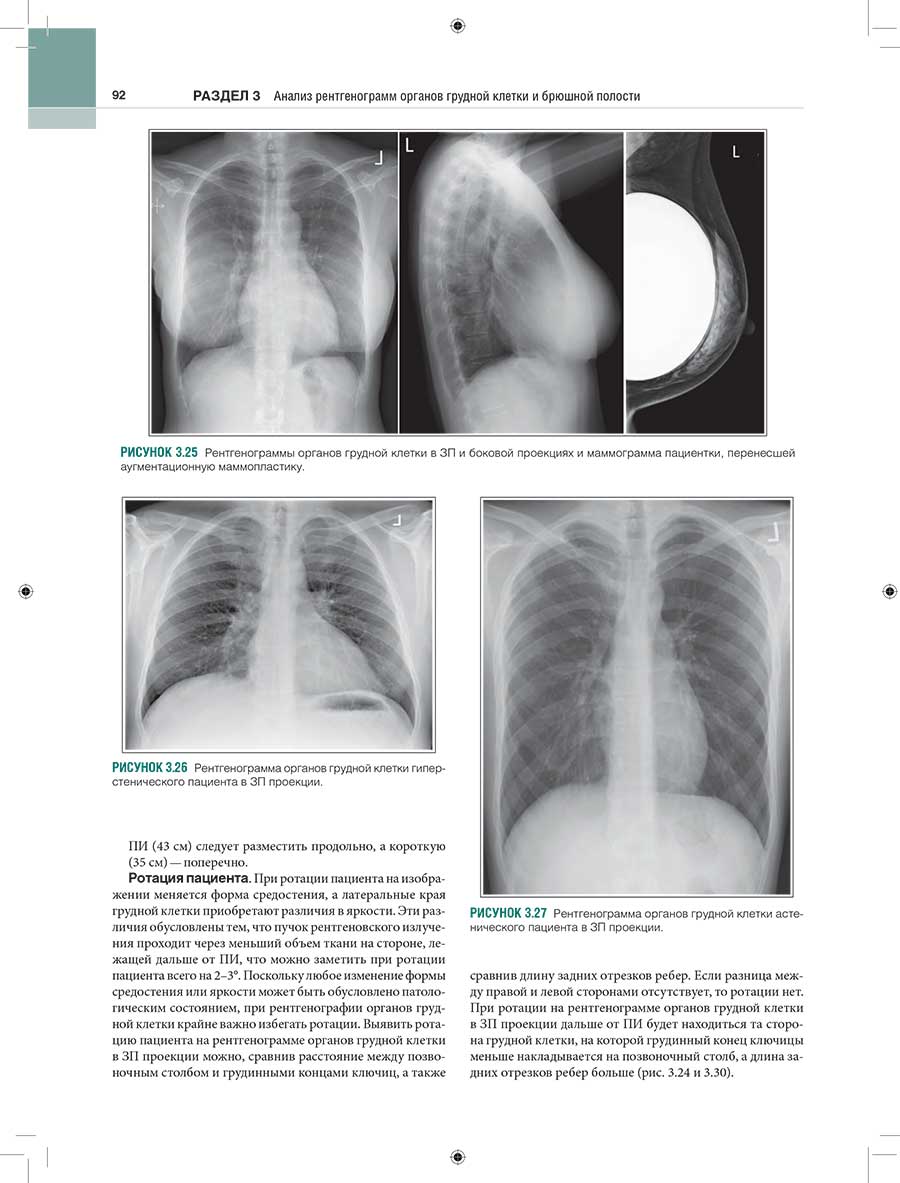 Рисунок 3.26 Рентгенограмма органов грудной клетки гиперстенического пациента в ЗП проекции.