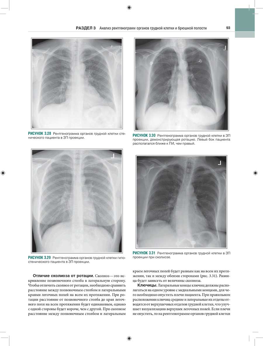 Рисунок 3.29 Рентгенограмма органов грудной клетки гипо-стенического пациента в ЗП проекции.