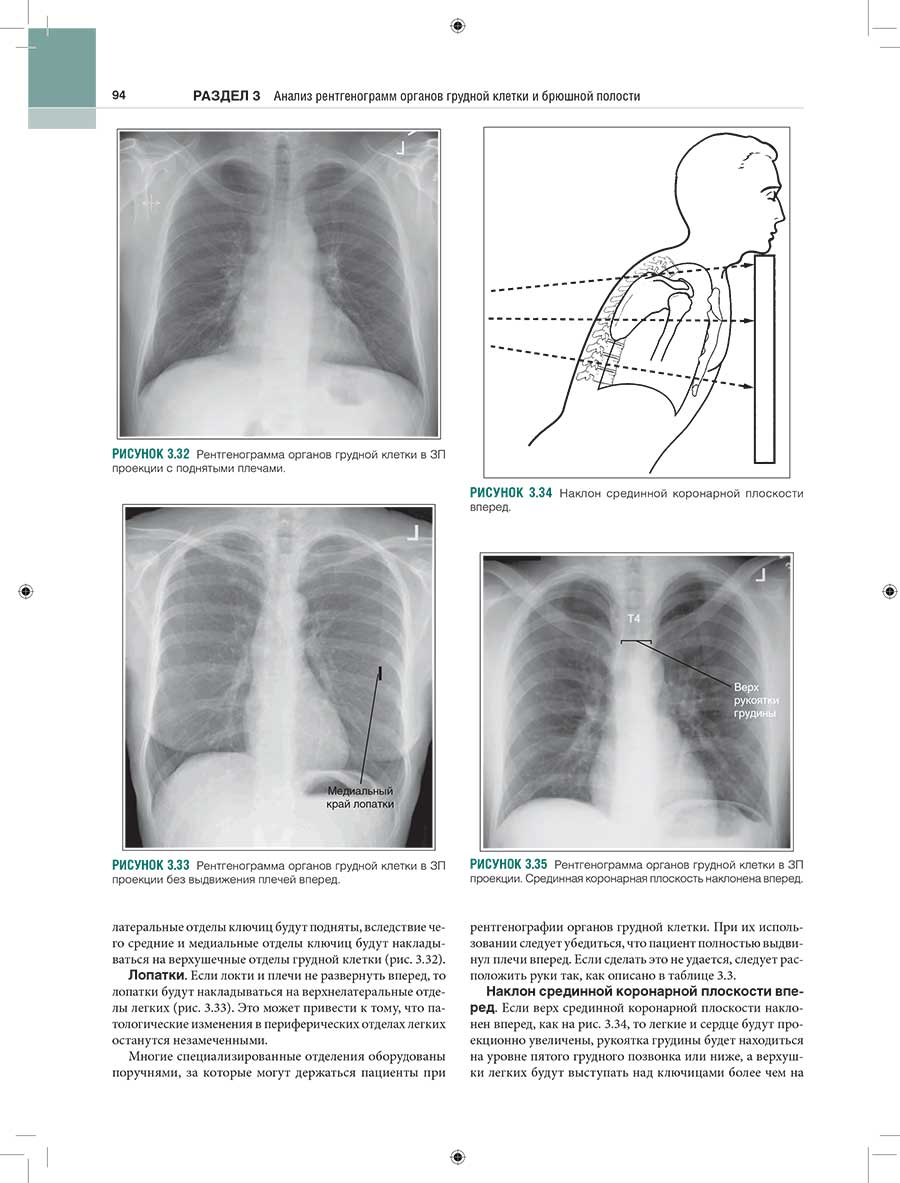 Рисунок 3.33 Рентгенограмма органов грудной клетки в ЗП проекции без выдвижения плечей вперед.