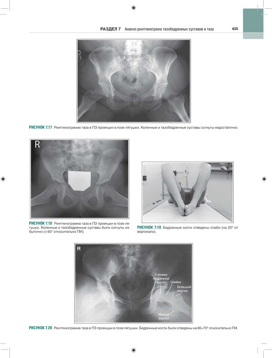 Рисунок 7.20 Рентгенограмма таза в ПЗ проекции а позе лягушки. Бедренные кости были отведены на 60-70 градусов относительно ПИ.