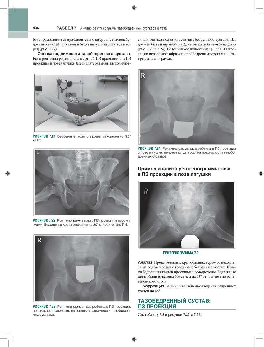 Пример анализа рентгенограммы таза в ПЗ проекции в позе лягушки