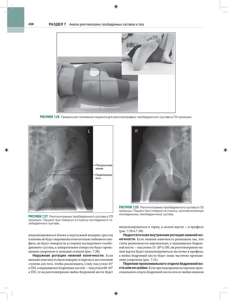 Рисунок 7.27 Рентгенограмма тазобедренного сустава в ПЗ проекции. Пациент был повернут в сторону исследуемого тазобедренного сустава.