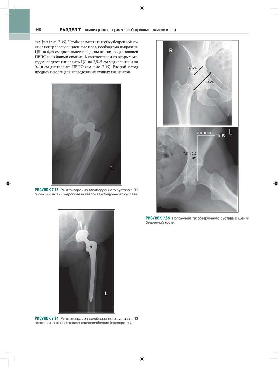 Рисунок 7.33 Рентгенограмма тазобедренного сустава в ПЗ проекции, вывих эндопротеза левого тазобедренного сустава