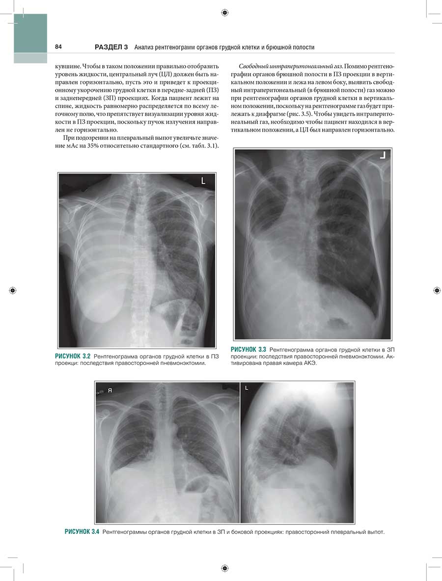 Рисунок 3.4 Рентгенограммы органов грудной клетки в ЗП и боковой проекциях: правосторонний плевральный выпот.