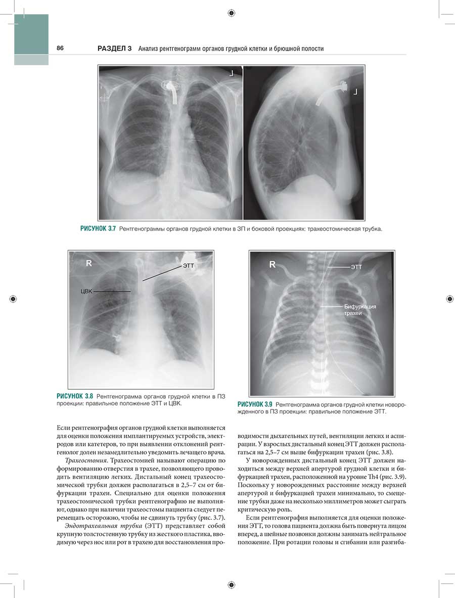 Рисунок 3.8 Рентгенограмма органов грудной клетки в ПЗ проекции: правильное положение ЭТТ и ЦБК.