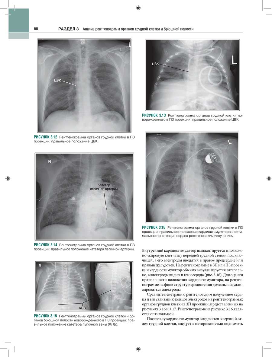 Рисунок 3.12 Рентгенограмма органов грудной клетки в ПЗ проекции: правильное положение ЦБК.