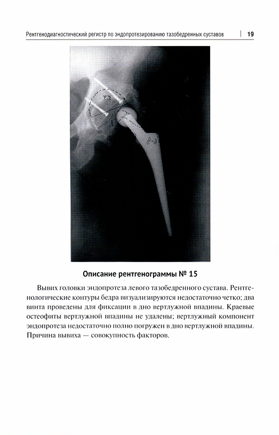 Вывих головки эндопротеза левою тазобедренного сустава. Вывих головки эндопротеза левою тазобедренного сустава.