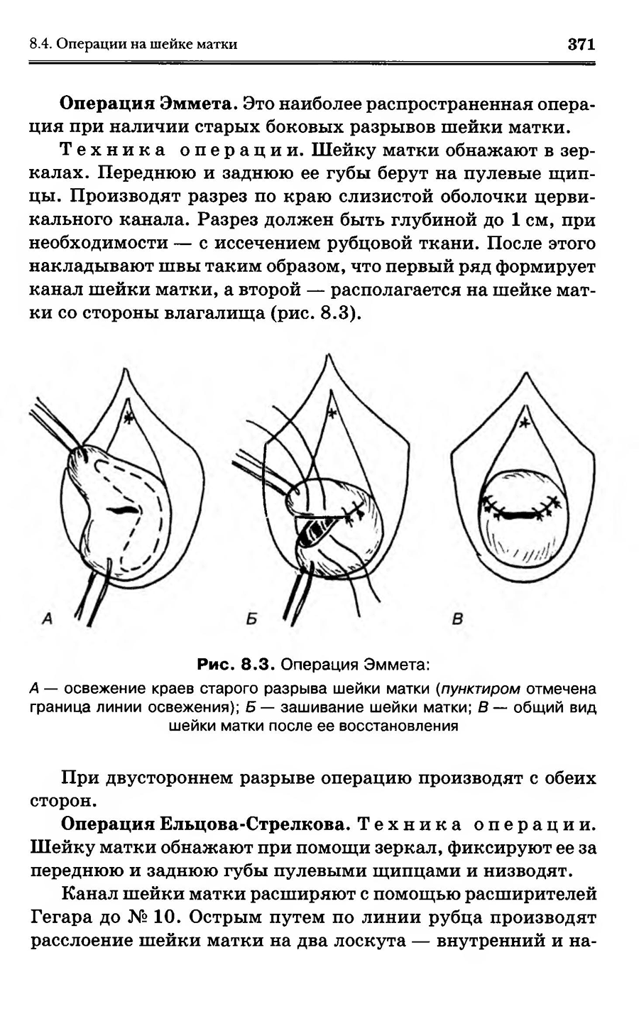 Рис. 8.3. Операция Эммета