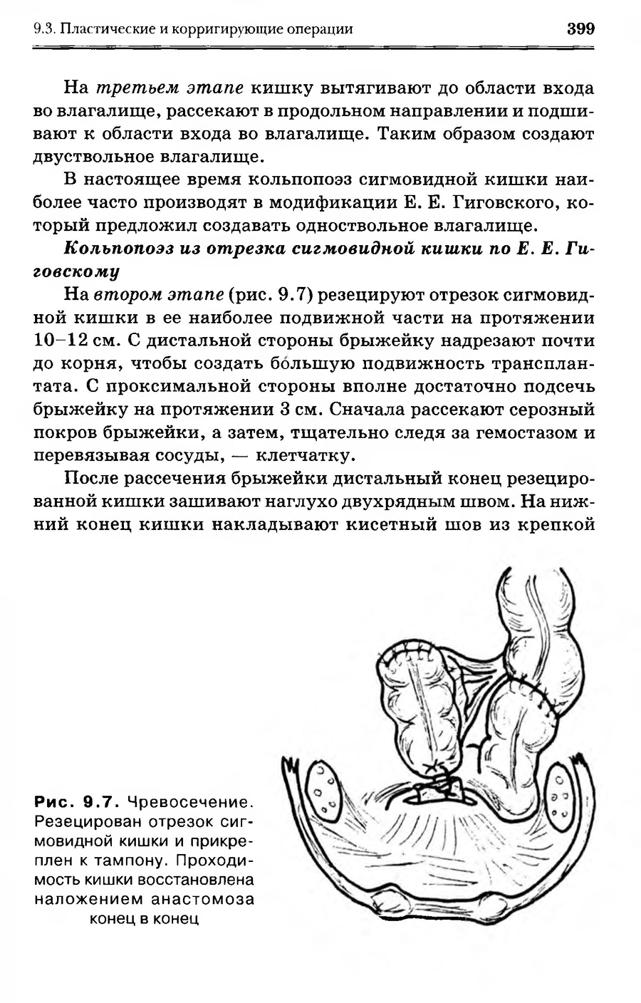 Рис. 9.7. Чревосечение. Резецирован отрезок 