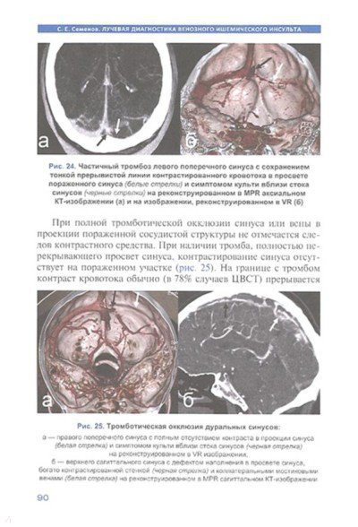 Пример страницы из книги "Лучевая диагностика венозного ишемического инсульта" - Семенов С. Е.