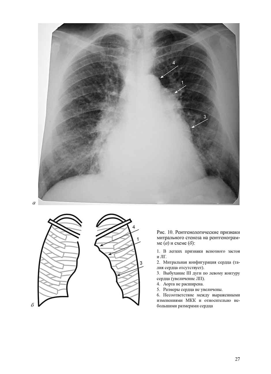 Рентгенологические признаки митрального стеноза на рентгенограмме (а) и схеме (б)