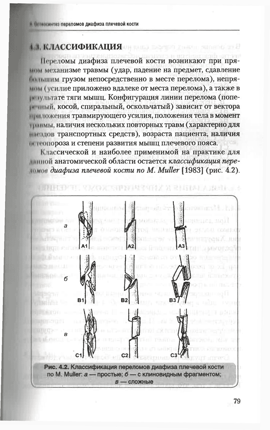 Рис. 4.2. Классификация переломов диафиза плечевой кости