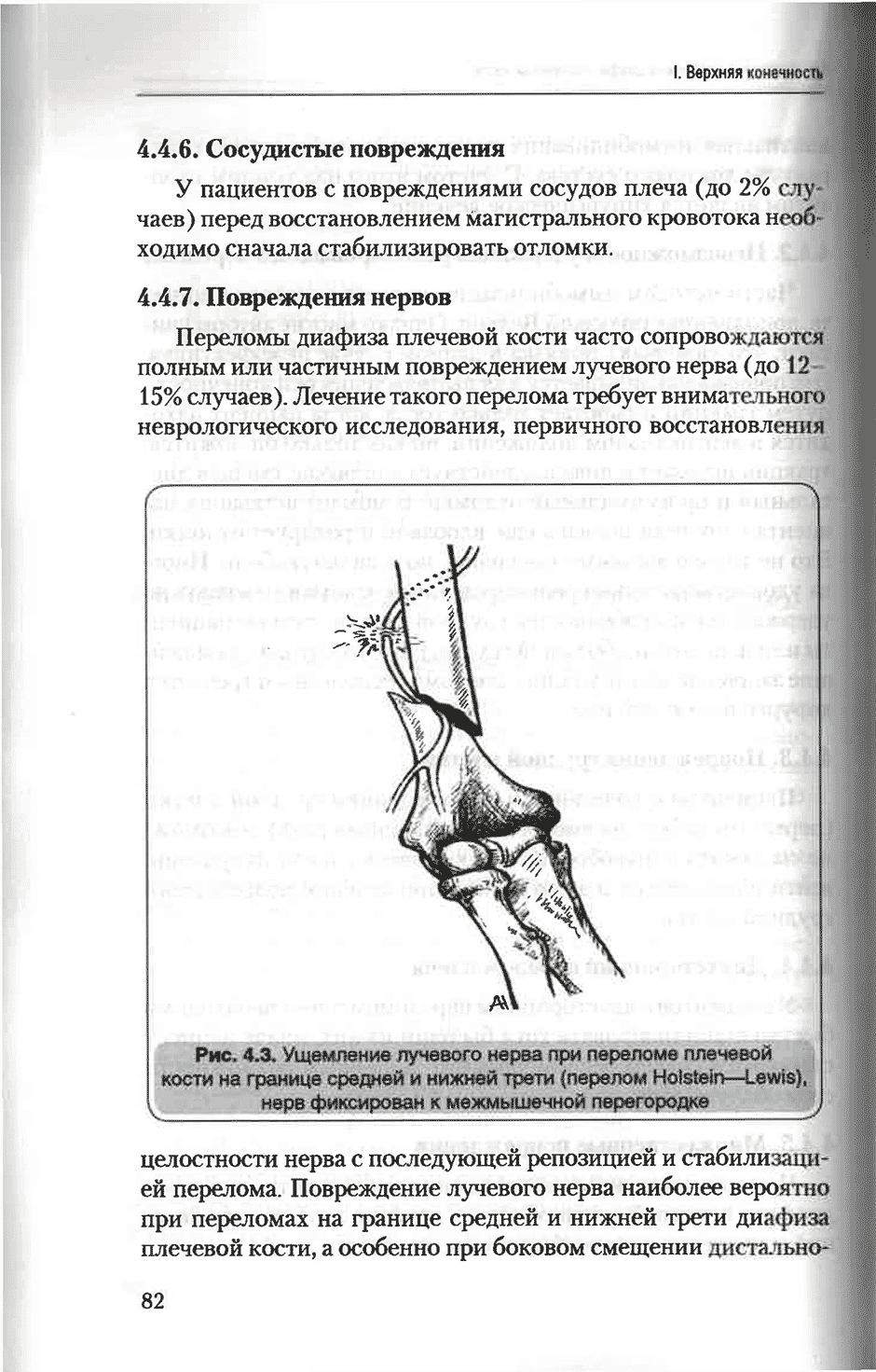 Рис. 4.3. Ущемление лучевого нерва при переломе плечевой