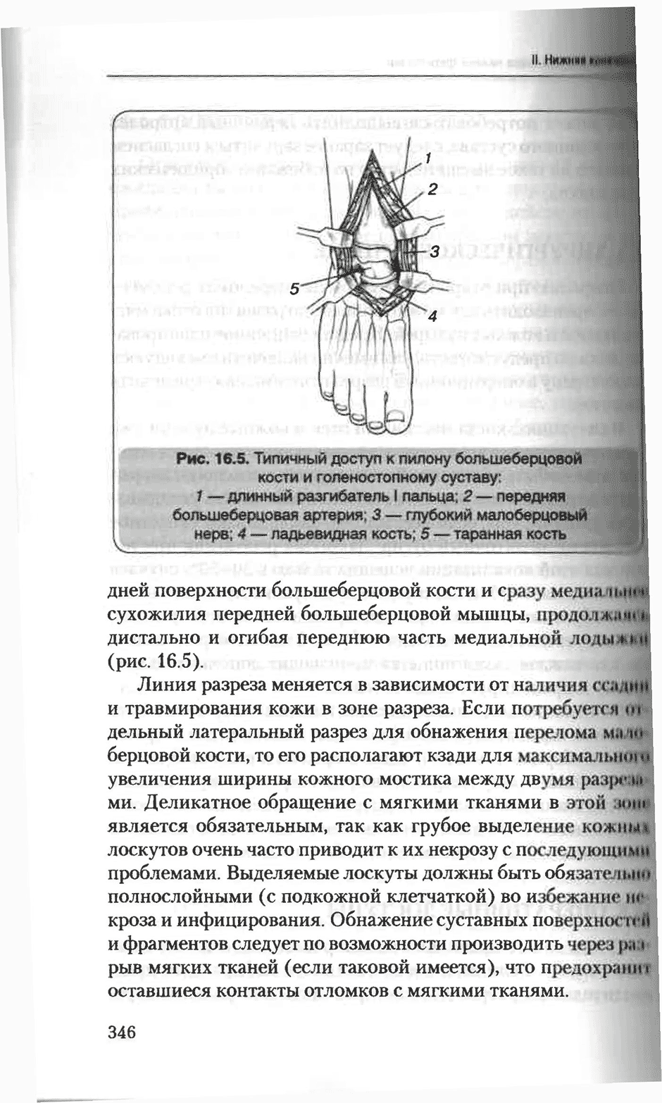 Рис. 16.5. Типичный доступ к пилону большеберцовой