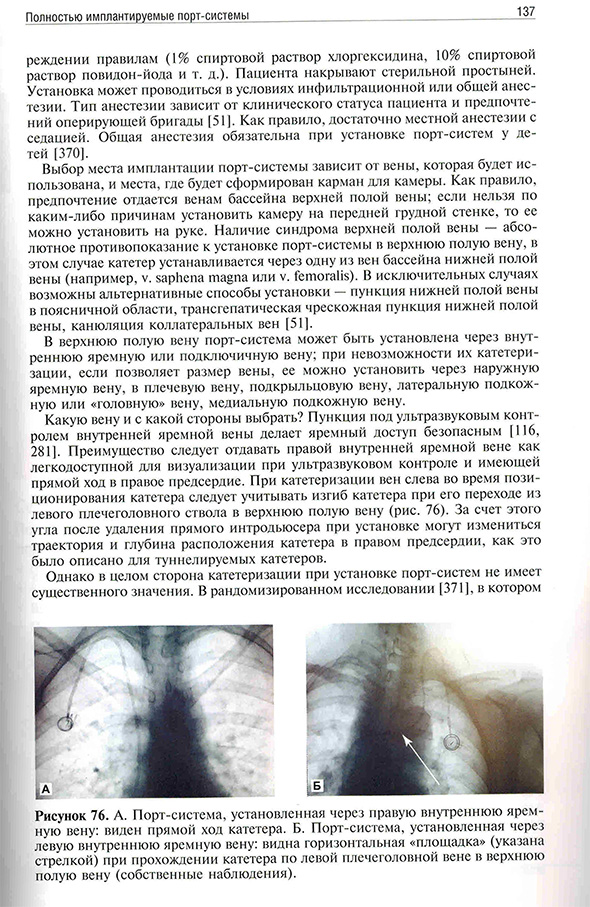 Рисунок 76. А. Порт-система, установленная через правую внутреннюю яремную вену: виден прямой ход катетера