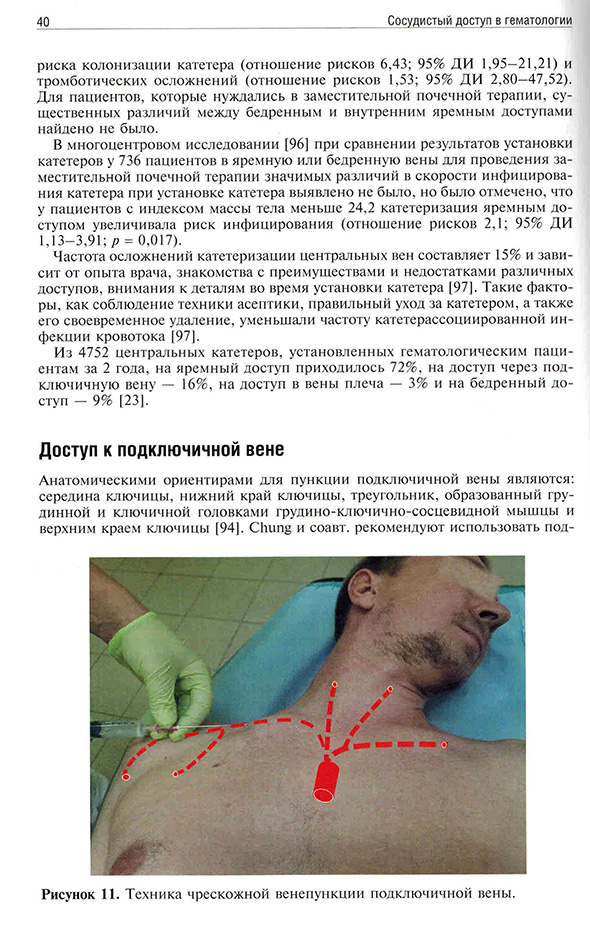 Техника чрескожной венепункции подключичной вены.