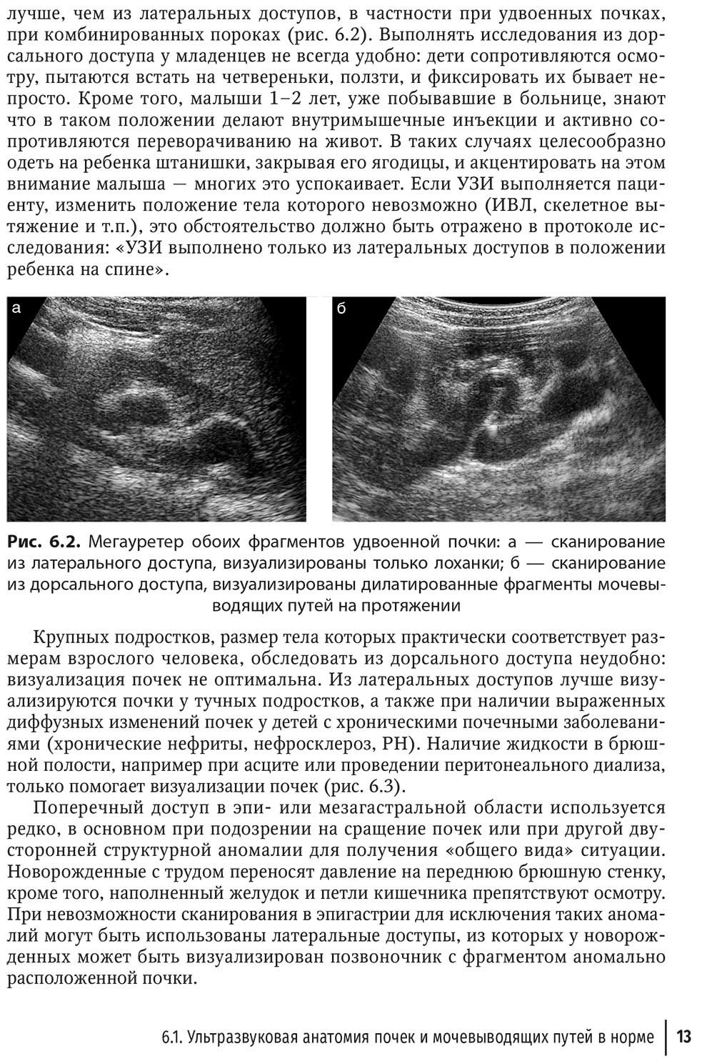 Мегауретер обоих фрагментов удвоенной почки