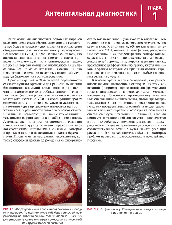 Омфалоцеле у 12-недельного плода с выпадением печени в мешок