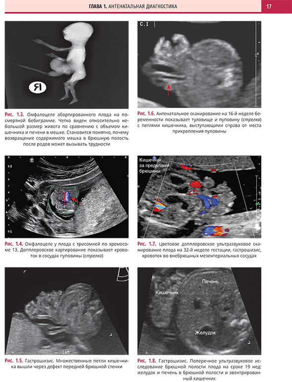 Рис. 1.5. Гастрошизис. Множественные петли кишечника вышли через дефект передней брюшной стенки