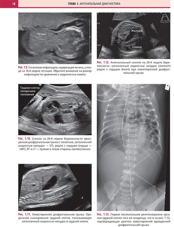 Левосторонняя диафрагмальная грыжа