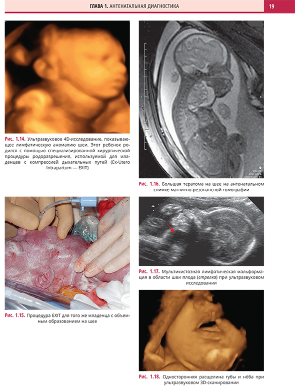 Больше тератома на шее на антенатальном снимке магнитно резонансной томографии