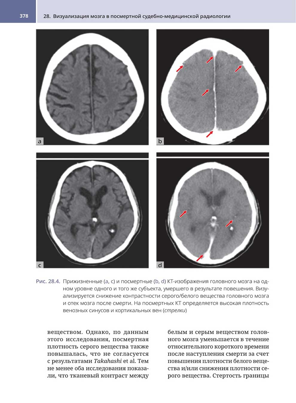 Рис. 28.4. Прижизненные (а, с) и посмертные (b, d) КТ-изображения головного мозга