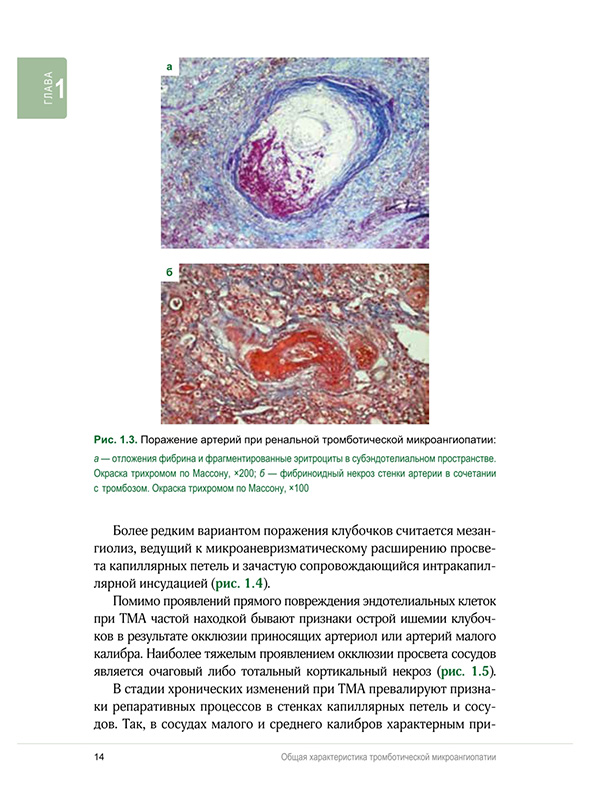 Поражение артерий при ренальной тромботической микроангиопатии