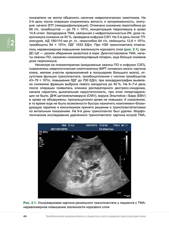 Ультразвуковая картина ренального трансплантата у пациента с ТМА: неравномерное повышение эхогенности коркового слоя