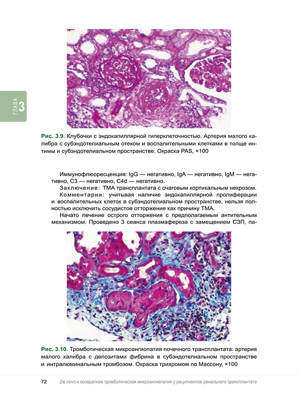 Тромботическая микроангиопатия почечного трансплантата:
