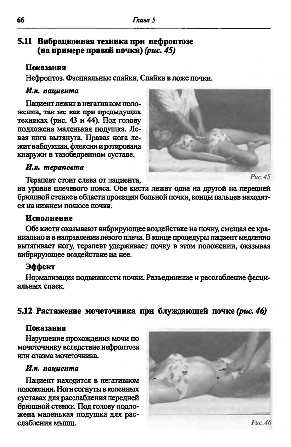 Растяжение мочеточника при блуждающей почке