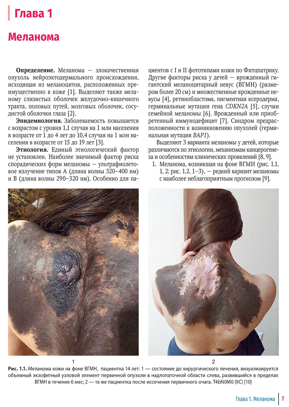 Меланома кожи на фоне ВГМН, пациентка 14 лет