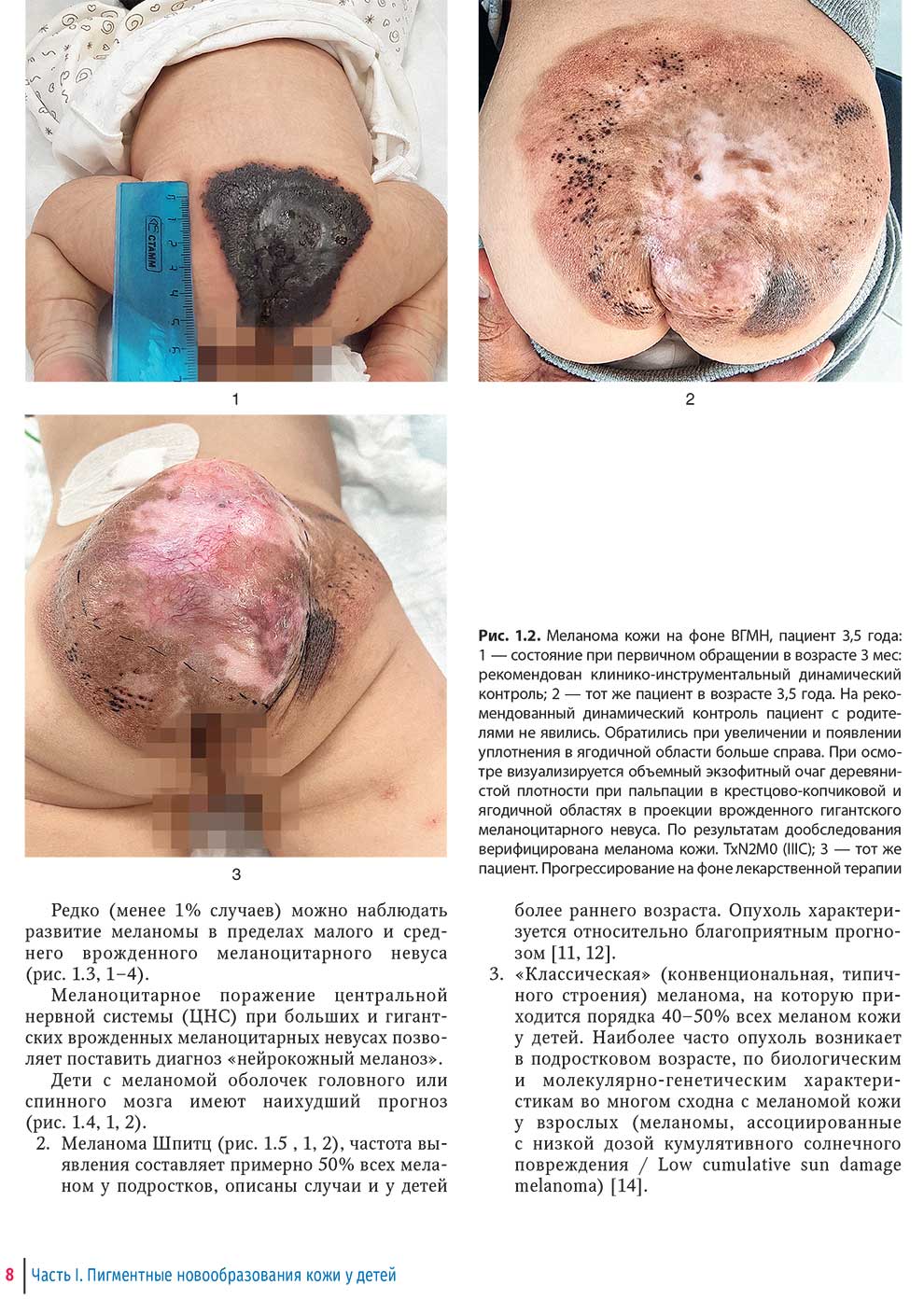 Меланома кожи на фоне ВГМН, пациент 3,5 года