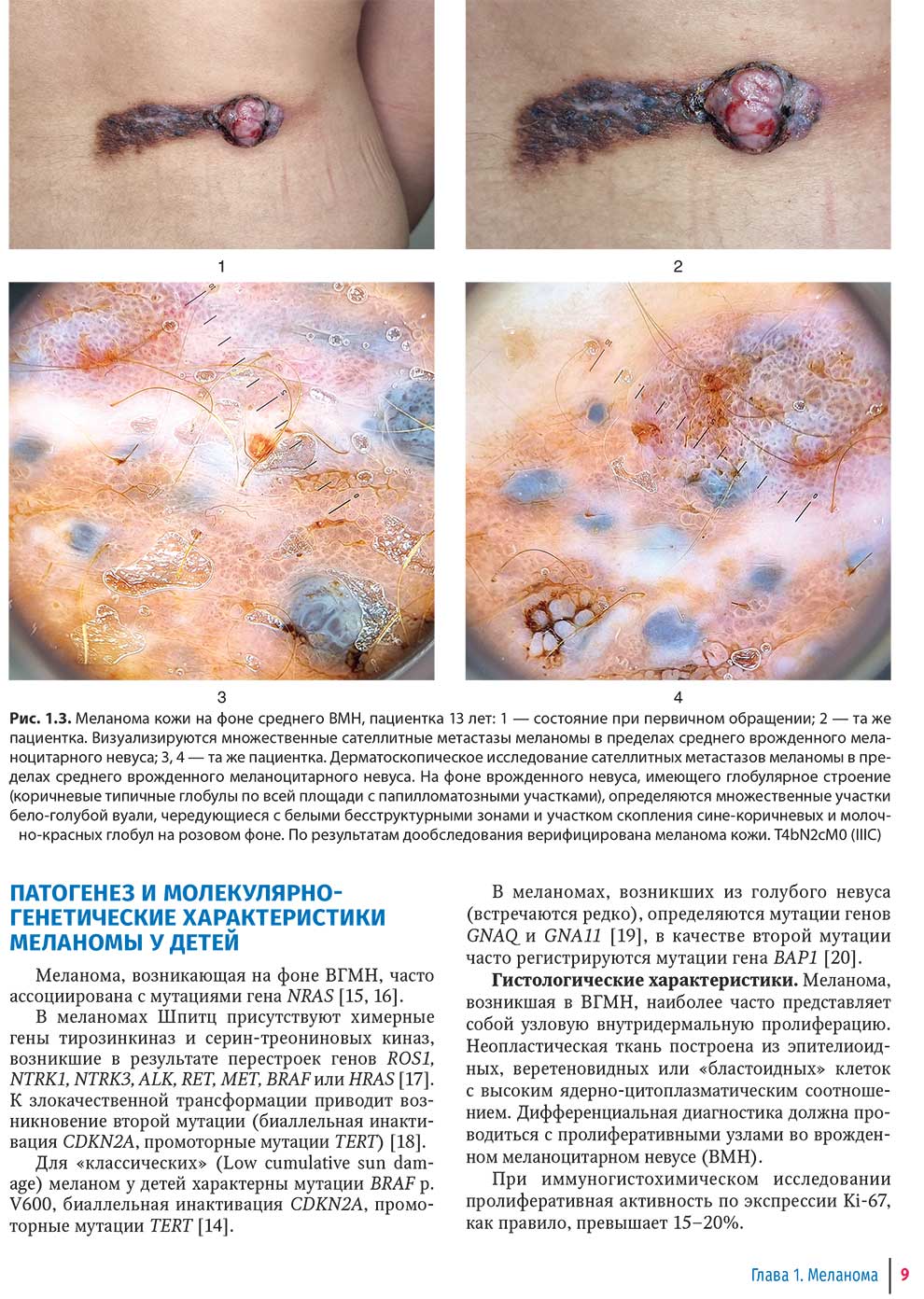 Меланома кожи на фоне среднего ВМН, пациентка 13 лет