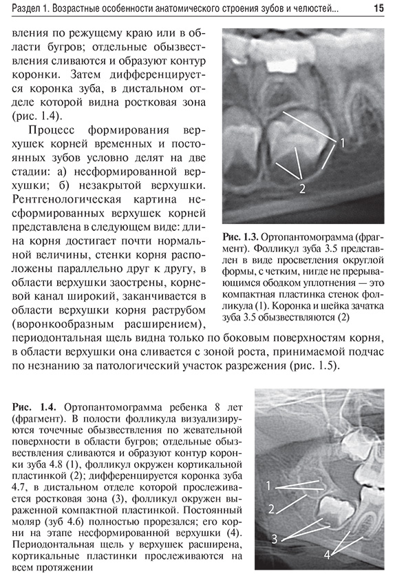 Рис. 1.4. Ортопантомограмма ребенка 8 лет (фрагмент). В полости фолликула визуализируются точечные обызвествления по жевательной. Рис. 1.4. Ортопантомограмма ребенка 8 лет (фрагмент). В полости фолликула визуализируются точечные обызвествления по жевательной.